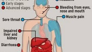 Ebola Virus Symptoms Treatment and Prevention [upl. by Hadeehsar]