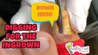 Digging For The Ingrown Nail Ingrown Nail Removal [upl. by Loferski871]