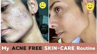 How I Got RID OF ACNE With Lifestyle Changes and CBD [upl. by Maynard102]