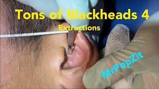 Tons of blackheads 4 Acne extractions Blackheads whiteheads milia Nose ears lips Pore dirt [upl. by Heiner562]