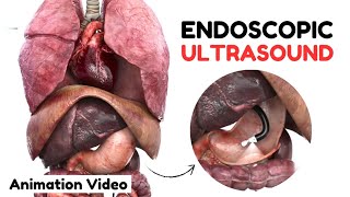 Endoscopic Ultrasound EUS  Animated Video [upl. by Guarino779]