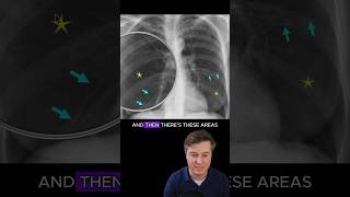 Emphysema on chest xray [upl. by Auqinu]