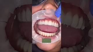 Ultra Thin Contact Veneers [upl. by Anelaj]