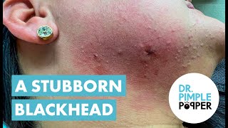 Dr Pimple Popper Helps With Blackhead Cyst [upl. by Debbee594]