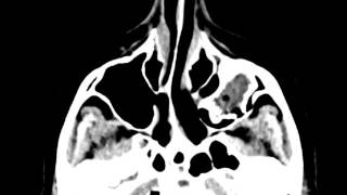 Odontogenic Ossifying Fibroma [upl. by Renba]