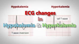 Hypokalemia and Hyperkalemia ECG changes [upl. by Eves762]