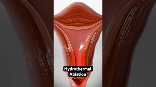 Using heated fluid to stop heavy periods 3D Animation [upl. by Karina562]