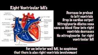 Tintinallis Emergency Medicine 8th edition video  ECG Right Ventricular MI [upl. by Calabrese910]