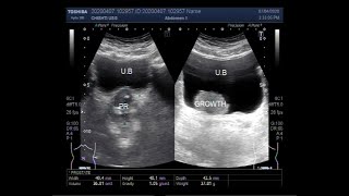 Ultrasound Video showing a Tumor in Urinary Bladder [upl. by Hanschen46]