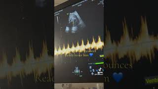 31 Weeks Sonogram [upl. by Ahel]