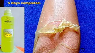 Hand Peeling Rules Step By step  2 Hands Difference  Whitening amp Spot Remove  Sunburn Remove [upl. by Aioj]