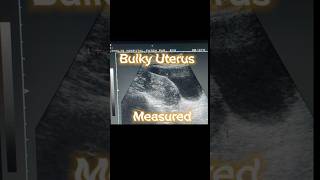 Bulky Uterus  Heterogenous Variable Texture of Uterus  Ovarian Cysts  Adnexa Cyst on Ultrasound [upl. by Giovanna]