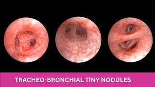 TRACHEOBRONCHIAL NODULES  Cobblestone Appearance [upl. by Buiron]