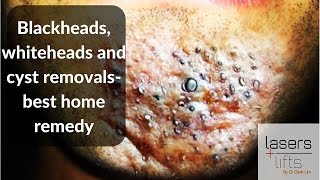 Blackheads whiteheads and cyst removal best home remedies [upl. by Dong]