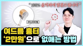 여드름 자국 흉터 없애는 방법ㅣ의사가 알려주는 여드름흉터 [upl. by Erland]