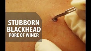 Stubborn Blackhead Removal  Dr Derm [upl. by Lecram]