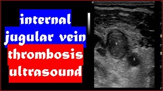 Internal jugular vein thrombosis Ultrasound [upl. by Llenaej]