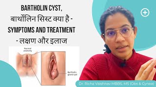 Bartholin cyst बार्थोलिन सिस्ट क्या है  symptoms and treatment  लक्षण और इलाज Bartholin abscess [upl. by Yznil]