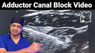 ADDUCTOR CANAL BLOCK Ultrasound Video  Saphenous nerve amp Nerve to Vastus Medialis  NVM Block [upl. by Elleirbag816]