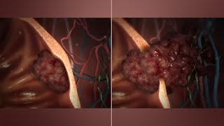 Granulomatous Lobular Mastitis A Clinicopathological Study [upl. by Broome]