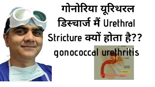 मूत्रमार्ग निंदा urethral stricture Kyun Hota haiGONOCOCCAL URETHRITIS URETHRAL DISCHARGE [upl. by Partridge]