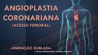 ANGIOPLASTIA CORONÁRIA Acesso Femoral  Animação dublada [upl. by Onitnelav640]