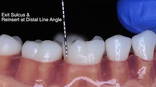 Periodontal Probe Basic Technique [upl. by Musetta272]