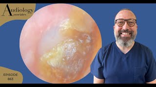 The Ultimate Earwax Removal A Painstaking Procedure  EP863 [upl. by Rinee258]