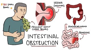 Intestinal Obstruction  Small Bowel Obstruction vs Large Bowel Obstruction [upl. by Jillene]