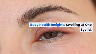 Swelling of One Eyelid Common Causes and When to Seek Medical Care  BuoyHealthcom [upl. by Svetlana]