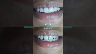 👍முன்பல் இடைவெளிக்கு தீர்வு  TEETH GAP TREATMENT IN TAMIL dranbudentist [upl. by Skiest]