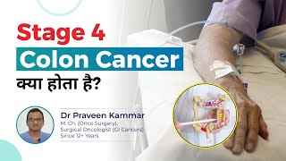 What Is Stage 4 Colon Cancer and How Does It Progress  Last Stage Colon Cancer  Dr Praveen Kammar [upl. by Dinerman]