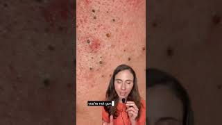 How to remove blackheads dermatologist blackheads blackheadremoval [upl. by Najar837]