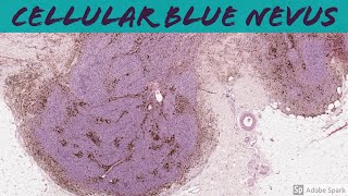 Cellular Blue Nevus 5Minute Pathology Pearls [upl. by Suicul588]