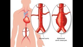 AORT ANEVRİZMALARININ TANISI TEDAVİSİ VE YÖNETİMİ [upl. by Prima]