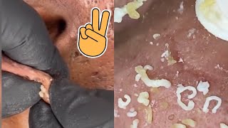 Big Cystic Acne Blackheads Extraction Blackheads amp Milia Whiteheads Removal Pimple Popping [upl. by Tnomed]