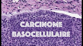 LE CARCINOME BASOCELLULAIRE  PATHOLOGIE [upl. by Eseneg]