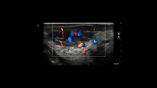 Hemangioma of the Tongue Ultrasound [upl. by Zampardi828]