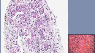 Surgical Pathology  Craniopharyngioma  UCLA Pituitary Tumor Program [upl. by Bogie]