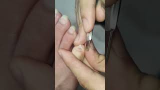 Very Deep Ingrown Toenail Removal [upl. by Winfrid]