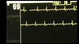 Atrial Flutter  ACLS Rhythm Recognition and Guidelines [upl. by Kalie]