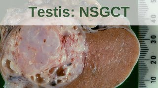 Testicular germ cell tumours  Non seminomatous germ cell tumours  Pathology mini tutorial [upl. by Naryb429]