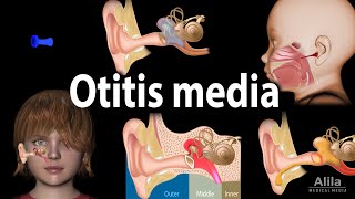 Otitis Media Anatomy Pathophysiology Risk Factors Types of OM Symptoms and Treatment Animation [upl. by Orazio203]