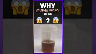 Why quot Brown Colour quot Urine [upl. by Anelac513]