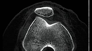 Lateral subluxation of patella [upl. by Bhayani]