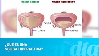 ¿Qué es una vejiga hiperactiva [upl. by Neeli289]