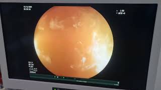 endoscopic sigmoid volvulus decompression [upl. by Navy]