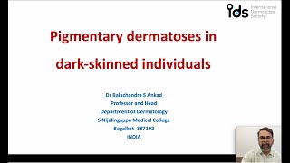 Pigmentary Dermatosis in dark skinned individuals  Dr Balachandra Ankad [upl. by Gottlieb29]