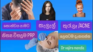 PRP  platelet rich plasma  treatment for pimples  scars and hair loss in Sinhala [upl. by Noisla]