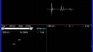 myopathic motor units deltoid [upl. by Hnad]